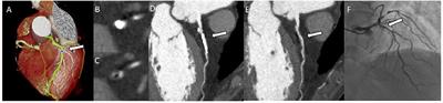 Diagnostic Accuracy of Subtraction Coronary CT Angiography in Severely Calcified Segments: Comparison Between Readers With Different Levels of Experience